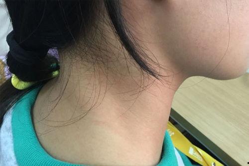 男网红脖子长肿瘤图片,关注健康生活刻不容缓